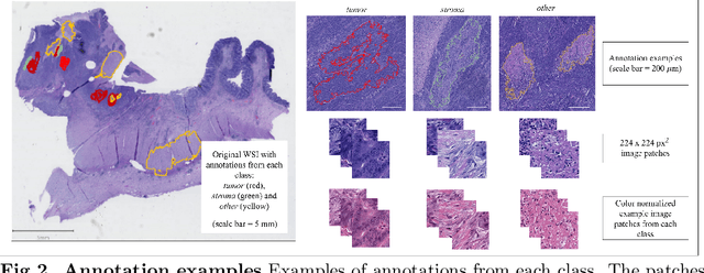 Figure 3 for Domain-specific transfer learning in the automated scoring of tumor-stroma ratio from histopathological images of colorectal cancer