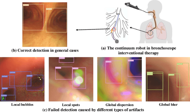 Figure 1 for CDFI: Cross Domain Feature Interaction for Robust Bronchi Lumen Detection