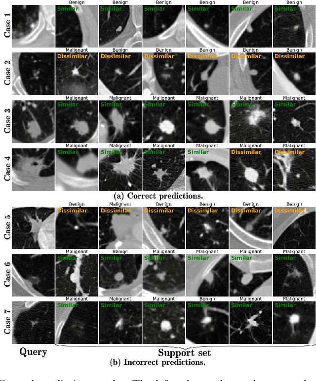 Figure 3 for ContrastDiagnosis: Enhancing Interpretability in Lung Nodule Diagnosis Using Contrastive Learning