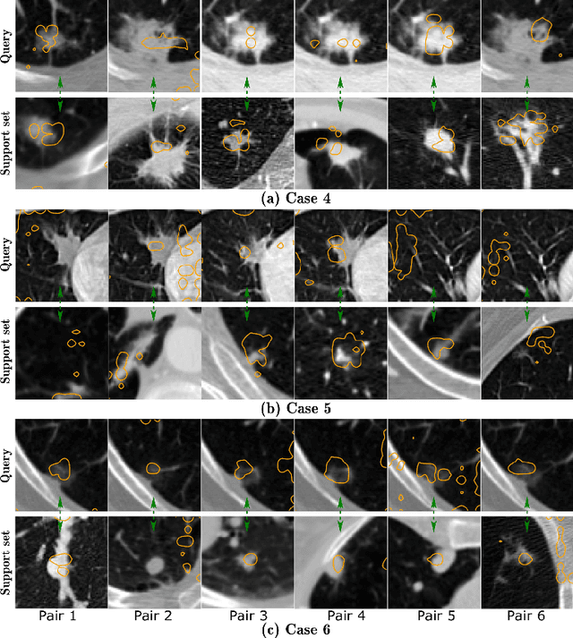 Figure 4 for ContrastDiagnosis: Enhancing Interpretability in Lung Nodule Diagnosis Using Contrastive Learning
