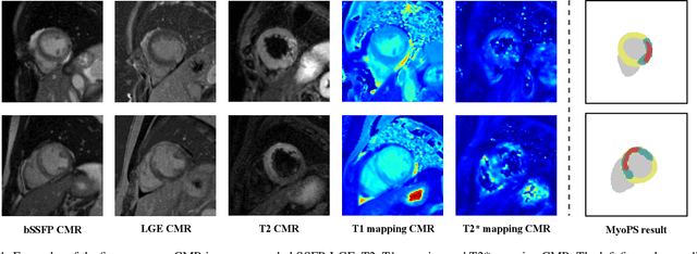 Figure 1 for MyoPS-Net: Myocardial Pathology Segmentation with Flexible Combination of Multi-Sequence CMR Images