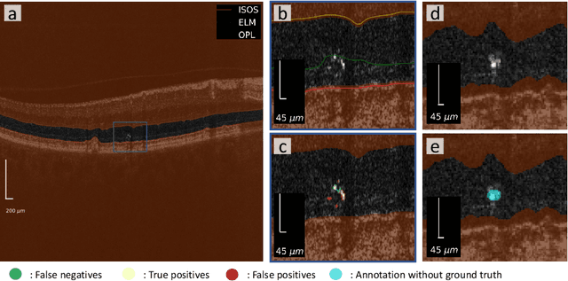 Figure 1 for Unsupervised detection of small hyperreflective features in ultrahigh resolution optical coherence tomography