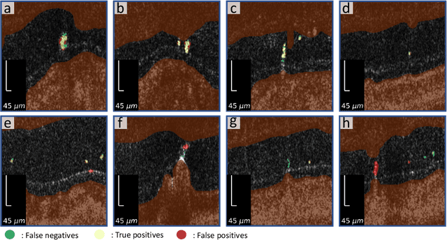 Figure 2 for Unsupervised detection of small hyperreflective features in ultrahigh resolution optical coherence tomography