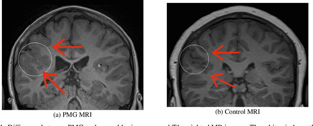 Figure 1 for A Novel Center-based Deep Contrastive Metric Learning Method for the Detection of Polymicrogyria in Pediatric Brain MRI