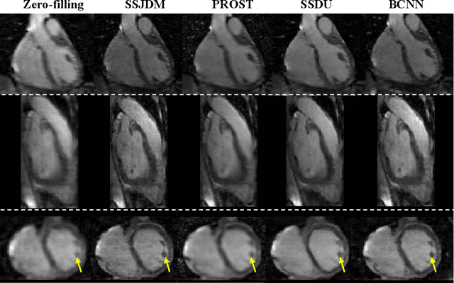 Figure 3 for Score-based Diffusion Models With Self-supervised Learning For Accelerated 3D Multi-contrast Cardiac Magnetic Resonance Imaging