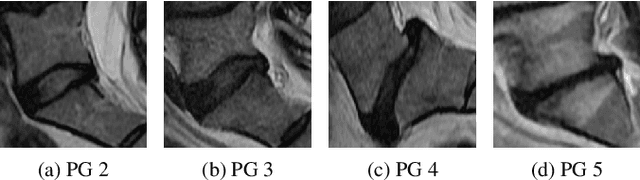 Figure 1 for A Stronger Baseline For Automatic Pfirrmann Grading Of Lumbar Spine MRI Using Deep Learning