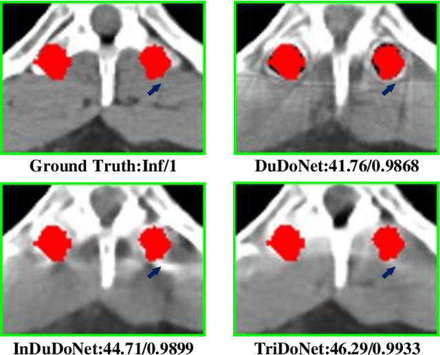 Figure 3 for TriDoNet: A Triple Domain Model-driven Network for CT Metal Artifact Reduction