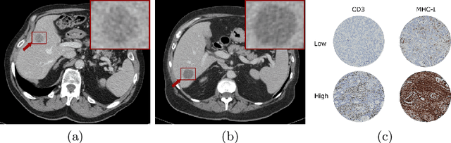 Figure 3 for Prediction of a T-cell/MHC-I-based immune profile for colorectal liver metastases from CT images using ensemble learning