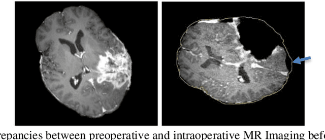 Figure 1 for Real-Time Dynamic Data Driven Deformable Registration for Image-Guided Neurosurgery: Computational Aspects