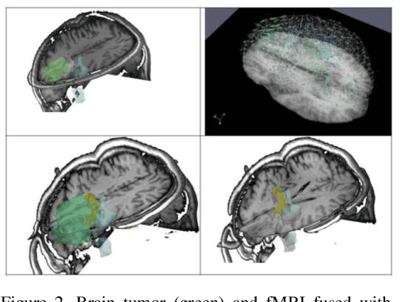 Figure 3 for Real-Time Dynamic Data Driven Deformable Registration for Image-Guided Neurosurgery: Computational Aspects