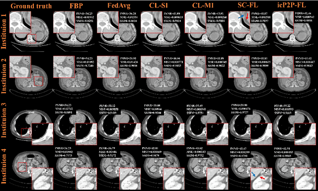 Figure 3 for A Peer-to-peer Federated Continual Learning Network for Improving CT Imaging from Multiple Institutions