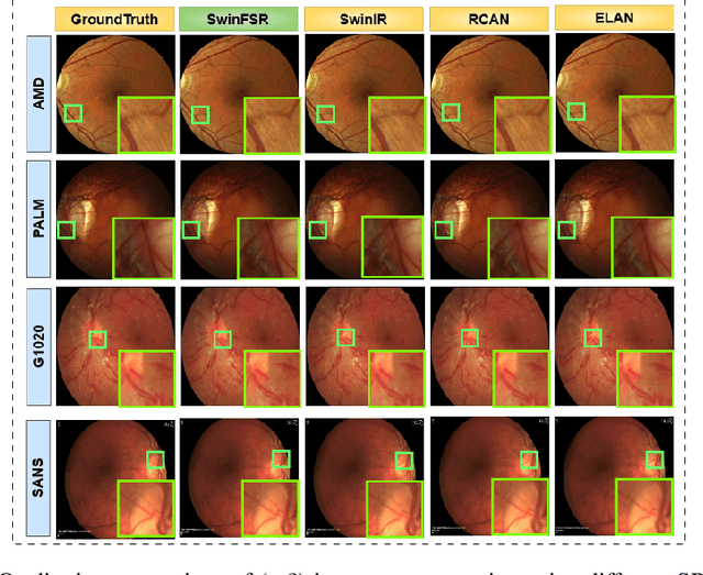 Figure 3 for Revolutionizing Space Health (Swin-FSR): Advancing Super-Resolution of Fundus Images for SANS Visual Assessment Technology