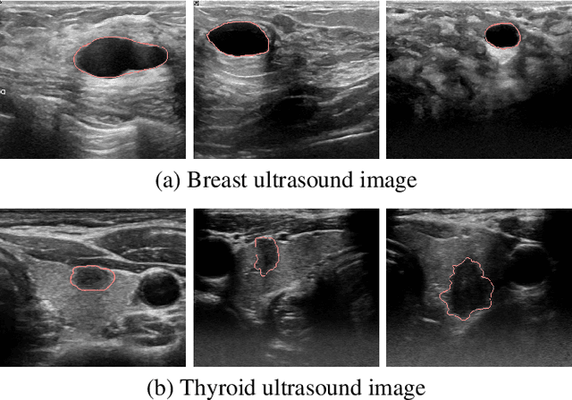 Figure 1 for CMU-Net: A Strong ConvMixer-based Medical Ultrasound Image Segmentation Network