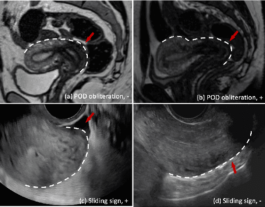 Figure 1 for Distilling Missing Modality Knowledge from Ultrasound for Endometriosis Diagnosis with Magnetic Resonance Images