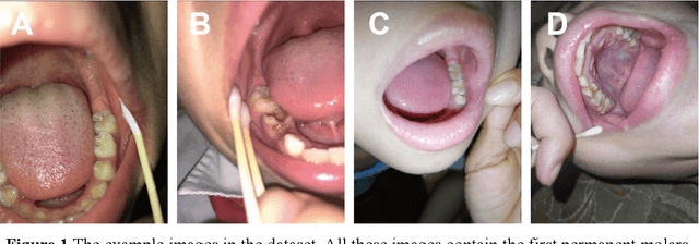 Figure 1 for Object Detection for Caries or Pit and Fissure Sealing Requirement in Children's First Permanent Molars