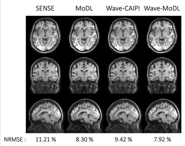 Figure 4 for Wave-Encoded Model-based Deep Learning for Highly Accelerated Imaging with Joint Reconstruction