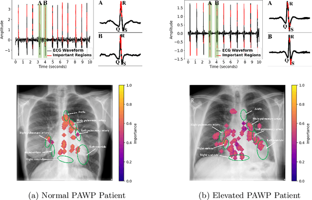Figure 4 for Multimodal Variational Autoencoder for Low-cost Cardiac Hemodynamics Instability Detection