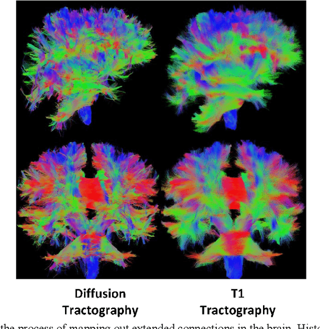 Figure 1 for Tractography with T1-weighted MRI and associated anatomical constraints on clinical quality diffusion MRI