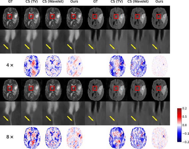 Figure 4 for Unsupervised Adaptive Implicit Neural Representation Learning for Scan-Specific MRI Reconstruction