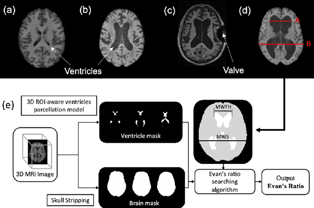 Figure 1 for Automated Ventricle Parcellation and Evan's Ratio Computation in Pre- and Post-Surgical Ventriculomegaly