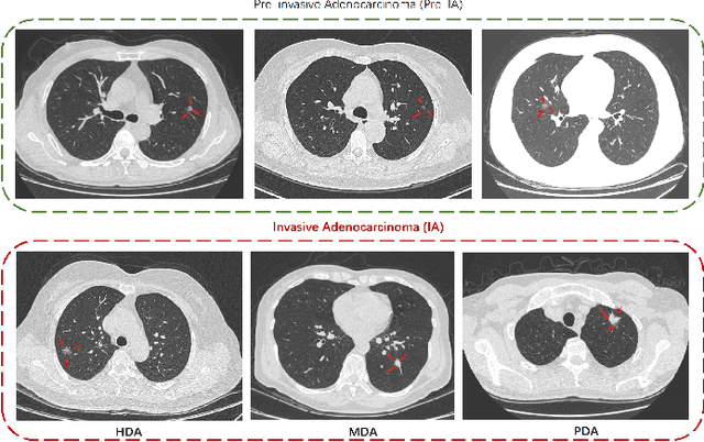Figure 1 for Adaptive Fusion of Radiomics and Deep Features for Lung Adenocarcinoma Subtype Recognition