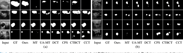 Figure 4 for Multi-Level Global Context Cross Consistency Model for Semi-Supervised Ultrasound Image Segmentation with Diffusion Model