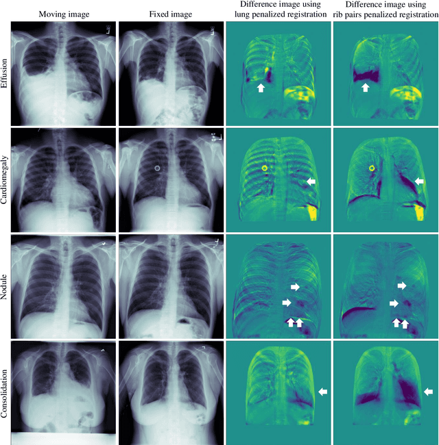 Figure 1 for Employing similarity to highlight differences: On the impact of anatomical assumptions in chest X-ray registration methods