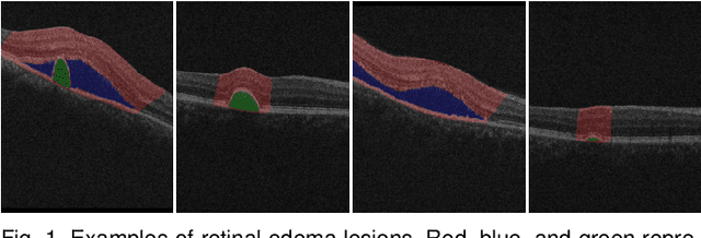 Figure 1 for Reliable Joint Segmentation of Retinal Edema Lesions in OCT Images