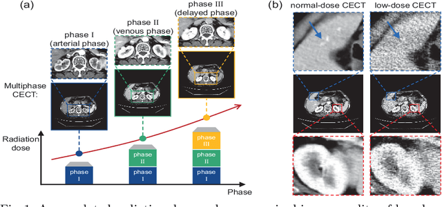 Figure 1 for JCCS-PFGM: A Novel Circle-Supervision based Poisson Flow Generative Model for Multiphase CECT Progressive Low-Dose Reconstruction with Joint Condition