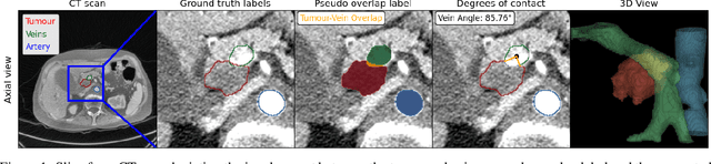 Figure 1 for Segmentation-based Assessment of Tumor-Vessel Involvement for Surgical Resectability Prediction of Pancreatic Ductal Adenocarcinoma