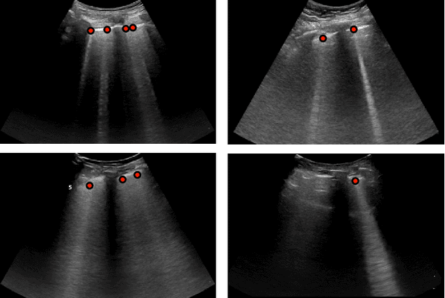 Figure 1 for Deep Learning for Detection and Localization of B-Lines in Lung Ultrasound