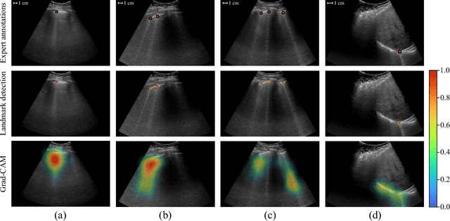 Figure 3 for Deep Learning for Detection and Localization of B-Lines in Lung Ultrasound