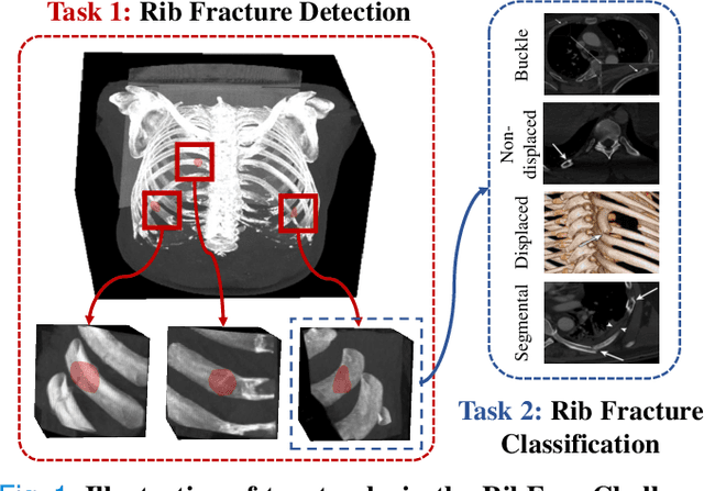 Figure 1 for Deep Rib Fracture Instance Segmentation and Classification from CT on the RibFrac Challenge