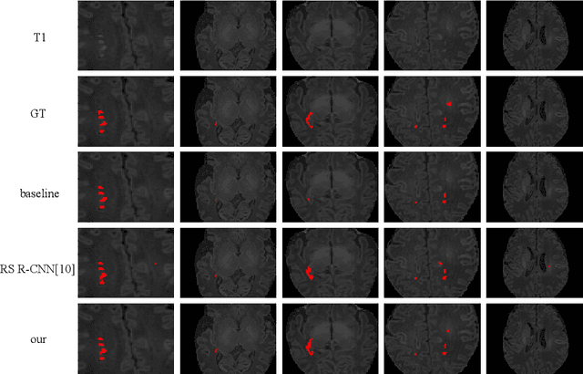 Figure 3 for Punctate White Matter Lesion Segmentation in Preterm Infants Powered by Counterfactually Generative Learning