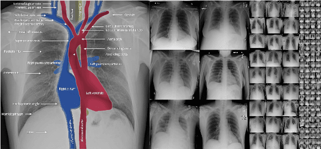 Figure 1 for Exploiting Structural Consistency of Chest Anatomy for Unsupervised Anomaly Detection in Radiography Images