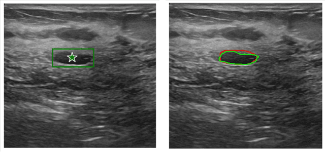 Figure 3 for BreastSAM: A Study of Segment Anything Model for Breast Tumor Detection in Ultrasound Images