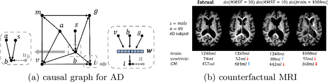 Figure 1 for Causal Image Synthesis of Brain MR in 3D