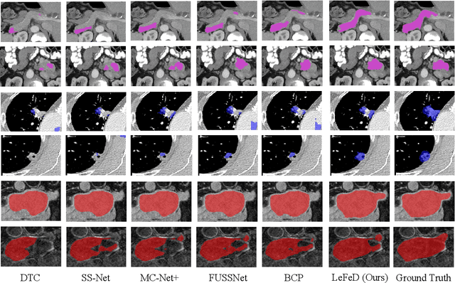 Figure 3 for Discrepancy Matters: Learning from Inconsistent Decoder Features for Consistent Semi-supervised Medical Image Segmentation