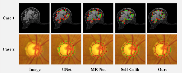Figure 4 for Learning Agreement from Multi-source Annotations for Medical Image Segmentation
