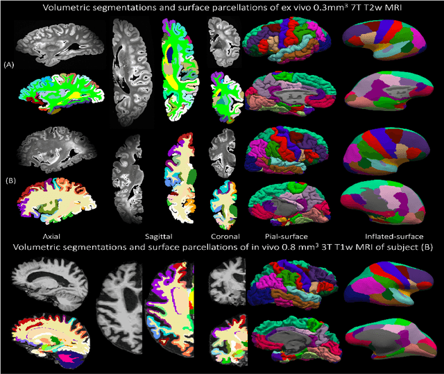 Figure 1 for Surface-based parcellation and vertex-wise analysis of ultra high-resolution ex vivo 7 tesla MRI in neurodegenerative diseases