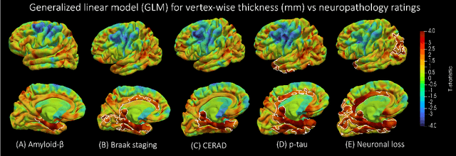 Figure 4 for Surface-based parcellation and vertex-wise analysis of ultra high-resolution ex vivo 7 tesla MRI in neurodegenerative diseases