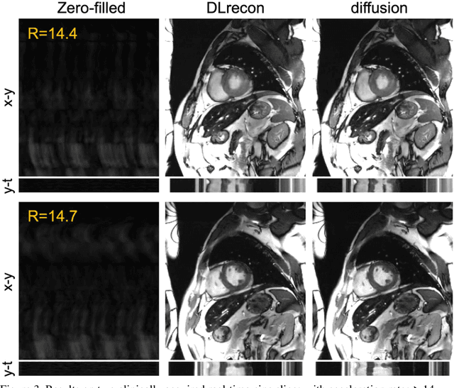 Figure 4 for Clinically Feasible Diffusion Reconstruction for Highly-Accelerated Cardiac Cine MRI