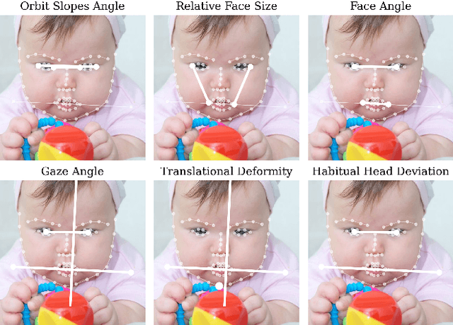 Figure 1 for Automatic Assessment of Infant Face and Upper-Body Symmetry as Early Signs of Torticollis