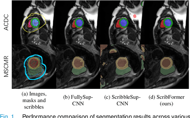 Figure 1 for ScribFormer: Transformer Makes CNN Work Better for Scribble-based Medical Image Segmentation