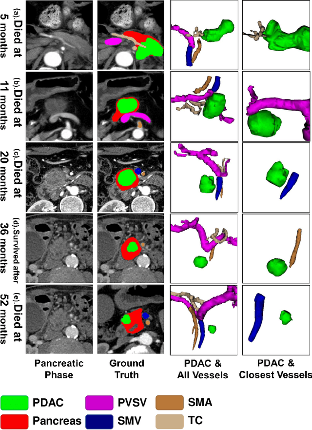 Figure 3 for Improved Prognostic Prediction of Pancreatic Cancer Using Multi-Phase CT by Integrating Neural Distance and Texture-Aware Transformer