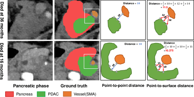 Figure 1 for Improved Prognostic Prediction of Pancreatic Cancer Using Multi-Phase CT by Integrating Neural Distance and Texture-Aware Transformer