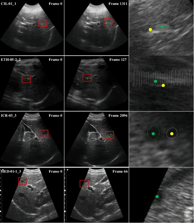 Figure 1 for LSDM: Long-Short Diffeomorphic Motion for Weakly-Supervised Ultrasound Landmark Tracking