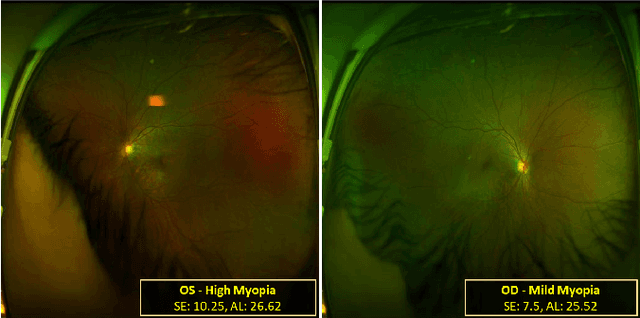 Figure 1 for OUCopula: Bi-Channel Multi-Label Copula-Enhanced Adapter-Based CNN for Myopia Screening Based on OU-UWF Images