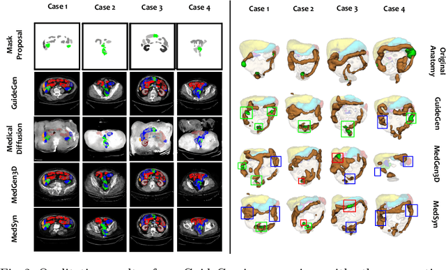 Figure 4 for GuideGen: A Text-guided Framework for Joint CT Volume and Anatomical structure Generation
