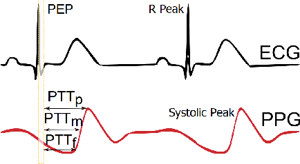 Figure 1 for PPG to ECG Signal Translation for Continuous Atrial Fibrillation Detection via Attention-based Deep State-Space Modeling